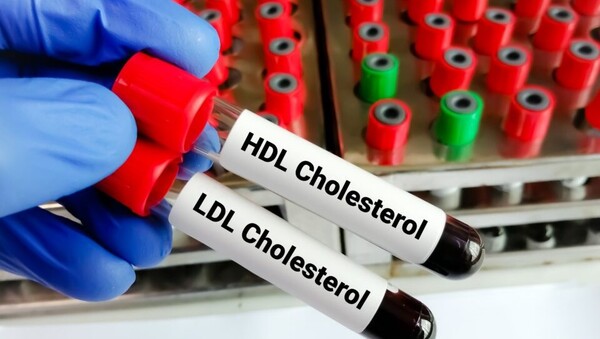 최근 연구에 따르면 고밀도지질단백질(HDL)로 알려진 “좋은 콜레스테롤”이 심혈관에 좋지만 높은 수준의 HDL은 알츠하이머병을 포함한 치매 위험 증가와 관련이 있는 것으로 알려졌다. [사진=어스닷컴]